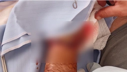 Трималася на шкірі: луцькі хірурги пришили чоловікові руку (фото 18+)