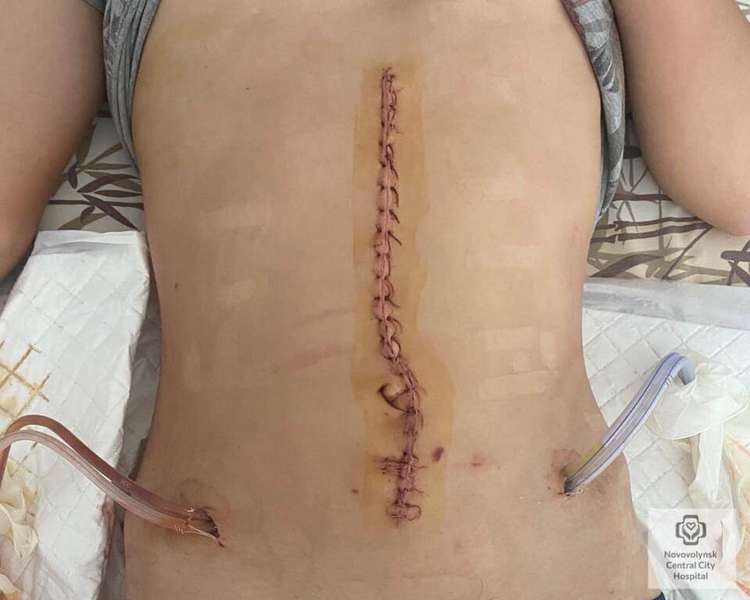 Розрив кишки: у Нововолинську хлопець впав з електросамоката (фото 18+)