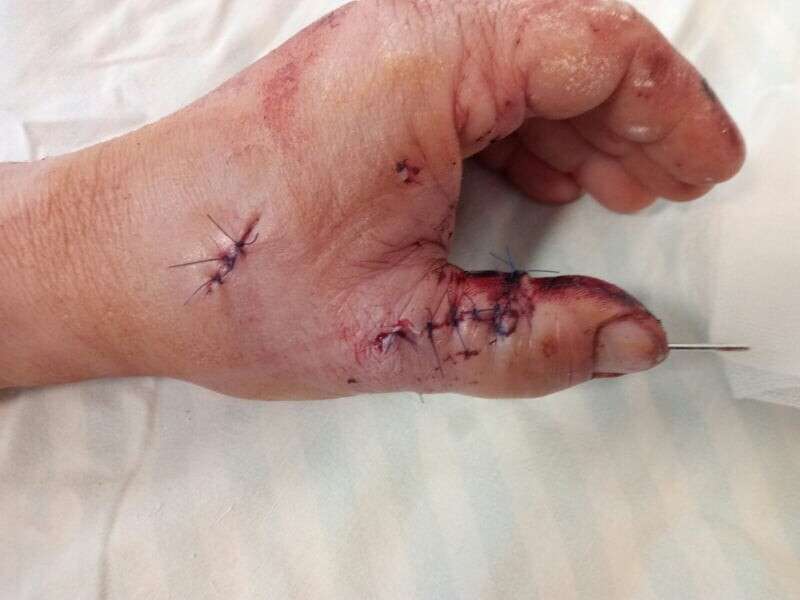 У Луцьку лікарі вперше пришили відрубаний палець (фото 18+)