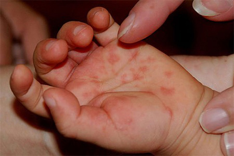 У Луцьку діти хворіють на вірус Коксакі: як розпізнати хворобу