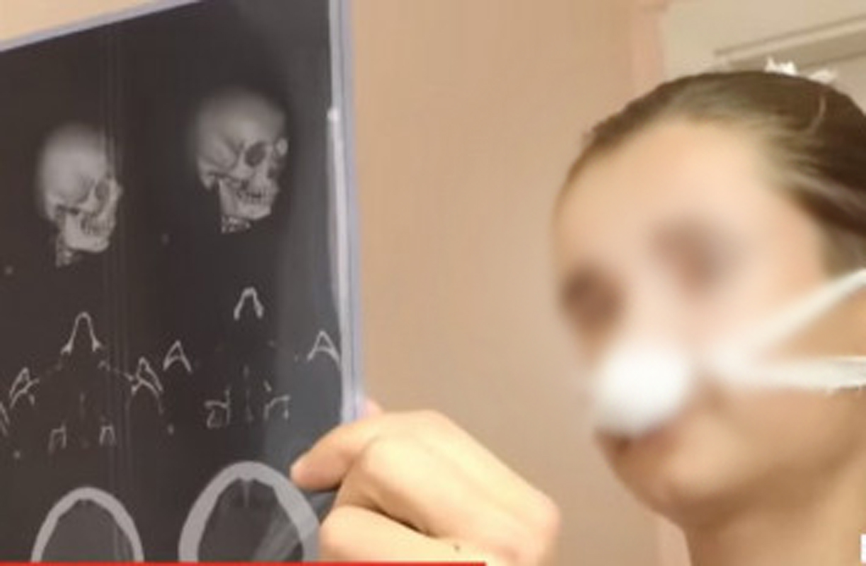 Студент «Монади» в Луцьку крав телефони та поламав дівчині ніс ліктем