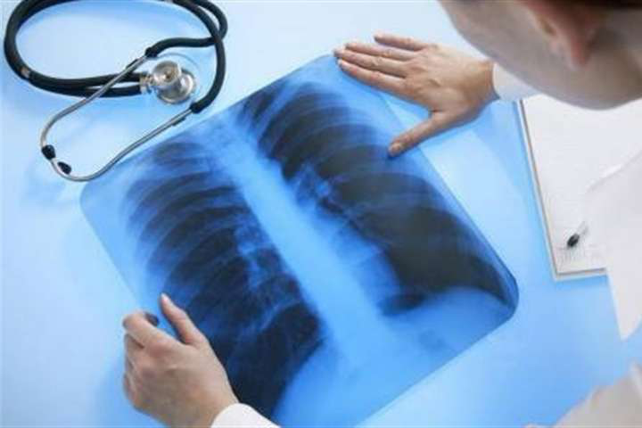 На Волині 12 медзакладів готові лікувати хворих на туберкульоз