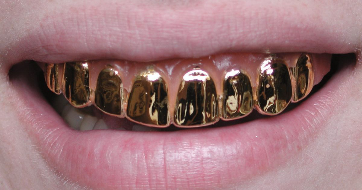 Було для протезів: на Рівненщині стоматолог вкрав золото на 320 тисяч